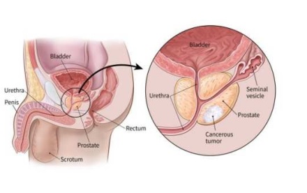 Prostatit Urertrit W