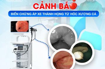 ​CẢNH BÁO: BIẾN CHỨNG ÁP XE THÀNH HỌNG TỪ HÓC XƯƠNG CÁ