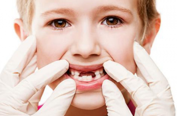 Bệnh lý sâu răng ở trẻ em và những điều cần biết
