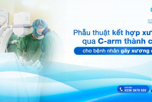 Phẫu thuật kết hợp xương qua C-arm thành công cho bệnh nhân gãy xương đòn