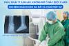 PHẪU THUẬT ÍT XÂM LẤN, KHÔNG MỞ Ổ GÃY DƯỚI C-ARM CHO BỆNH NHÂN DI LỆCH HAI MẮT CÁ CHÂN PHỨC TẠP