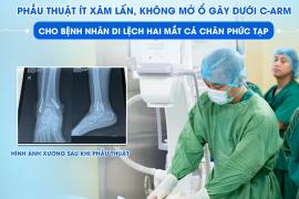 PHẪU THUẬT ÍT XÂM LẤN, KHÔNG MỞ Ổ GÃY DƯỚI C-ARM CHO BỆNH NHÂN GÃY DI LỆCH HAI MẮT CÁ CHÂN PHỨC TẠP
