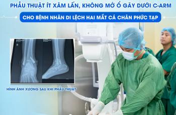 PHẪU THUẬT ÍT XÂM LẤN, KHÔNG MỞ Ổ GÃY DƯỚI C-ARM CHO BỆNH NHÂN GÃY DI LỆCH HAI MẮT CÁ CHÂN PHỨC TẠP
