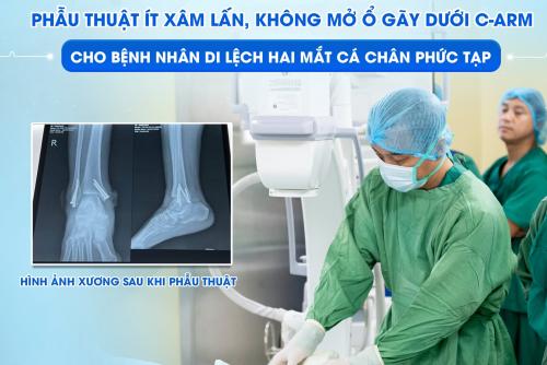 PHẪU THUẬT ÍT XÂM LẤN, KHÔNG MỞ Ổ GÃY DƯỚI C-ARM CHO BỆNH NHÂN GÃY DI LỆCH HAI MẮT CÁ CHÂN PHỨC TẠP