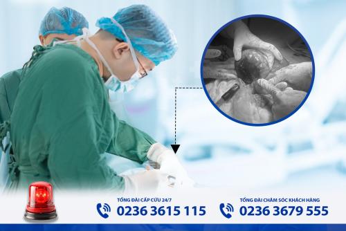 Phẫu thuật cắt đoạn ruột cấp cứu cho bệnh nhân xoắn ruột hoại tử tại Bệnh viện Đa khoa Tâm Trí Đà Nẵng