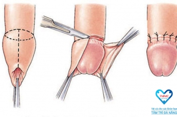 Công nghệ "Keo dán sinh học" trong điều trị hẹp bao quy đầu